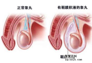 睾丸鞘膜积液的穴位疗法有哪些？