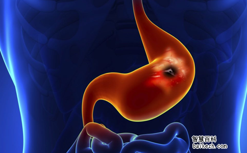 胃十二直肠溃疡急性穿孔的病因和病理