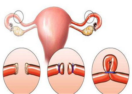 绝育输卵管结扎术前准备及手术步骤