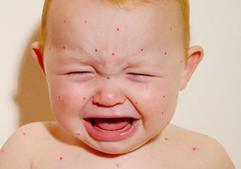 如何防治小儿湿疹？
