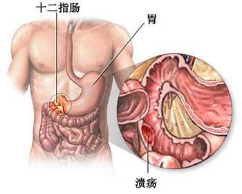 胃和十二指肠溃疡大出血的诊断和鉴别诊断的方