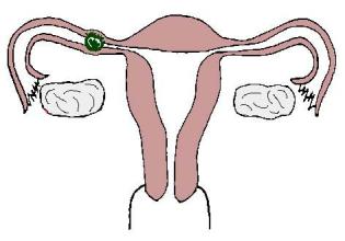 发生输卵管妊娠的原因及病理有什么？