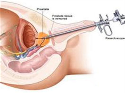 关于前列腺结石的长期用药的说明
