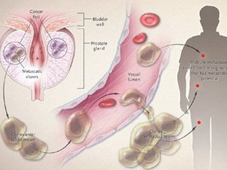 前列腺结核会引起哪些症状