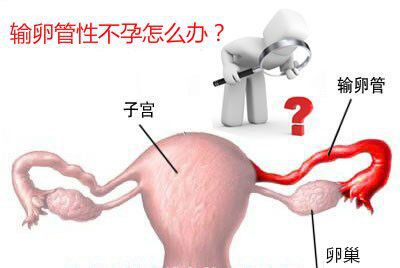 输卵管不孕的检查办法有哪些