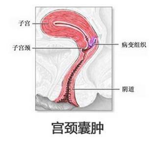 预防宫颈囊肿的措施有哪些