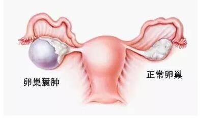 左侧卵巢囊肿的症状及自查和检查方法