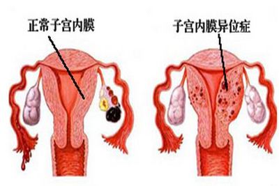 子宫内膜异位症原因及症状和预防