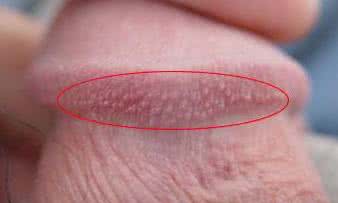尖锐湿疣和疱疹如何区分
