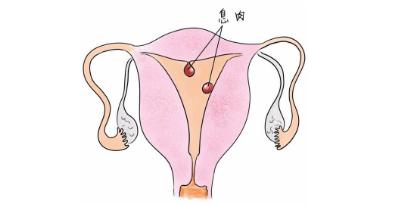 什么是子宫息肉及怎么诊断和影响怀孕吗