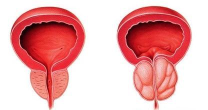 前列腺囊肿的吃什么好和症状