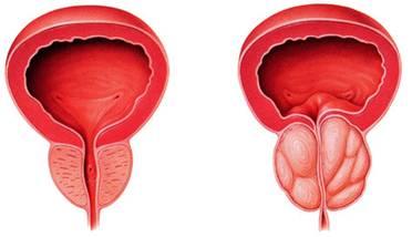 引起前列腺增生的原因 有哪些症状表现？