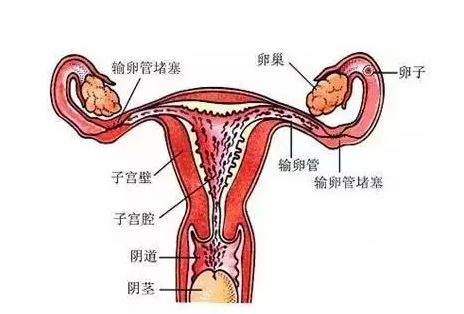 40%的不孕女性是由于输卵管因素所造成