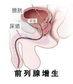 男性需小心前列腺增生带来的危害