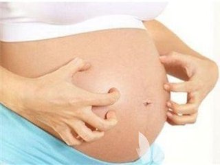怀孕期间肚皮发痒 可能是这几个原因