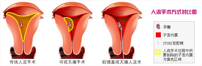 宫腔镜取胚术与无痛人流有什么不同