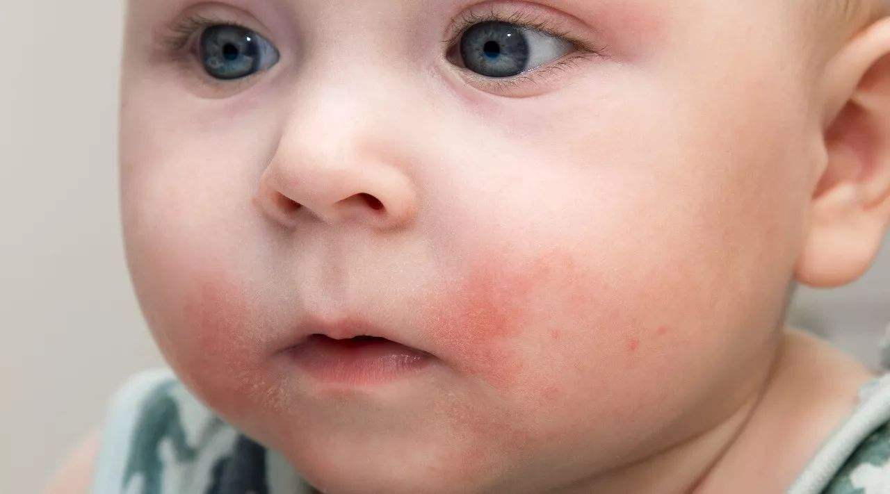 宝宝为什么会过敏？可以预防吗？