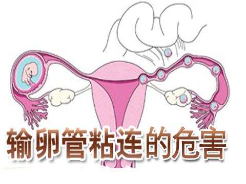 惊！双侧输卵管粘连导致女性不孕