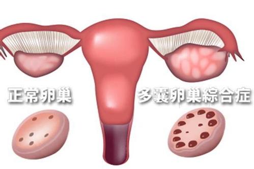 久备不孕的你 可能患了多囊卵巢综合征