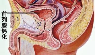 前列腺多发性钙化灶怎么回事