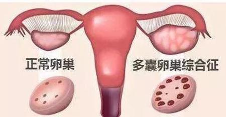 多囊卵巢综合症“怀孕的天敌”如何怀孕?