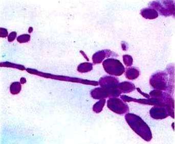 白色念珠菌的感染原因及检查和预防保健