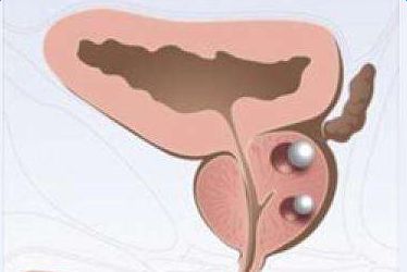 前列腺结石症状及危害和预防