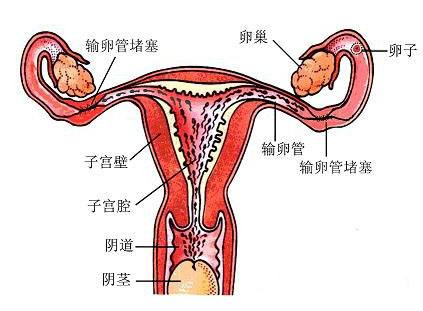 输卵管发育异常的症状及诊断和治疗