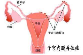 女子经常流鼻血，经诊断竟是子宫内膜异位!