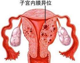 警惕!子宫内膜异位症导致女性不孕