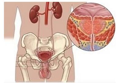 前列腺结核与阴茎结核，诊断依据与治疗方法介绍！