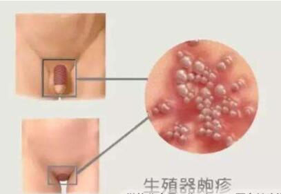 生殖器疱疹的症状表现有哪些？如何预防生殖器疱疹？