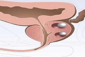 前列腺钙化斑是什么呢？前列腺钙化斑会致癌吗？