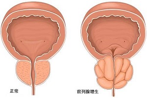前列腺大是否一定有症状？前列腺大是前列腺增生吗？