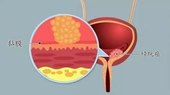 膀胱癌的致病因素有哪些？膀胱癌应如何治疗？