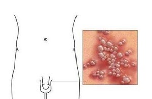 男性生殖器疱疹的原因是什么？有哪些危害？如何预防？