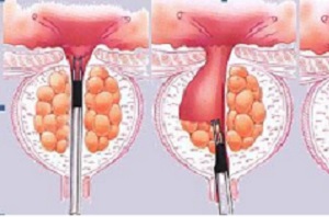 前列腺钙化的症状有哪些？如何预防前列腺钙化？
