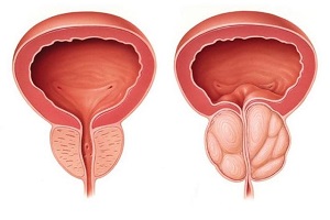 前列腺肥大如何治疗好？前列腺肥大的中医辨证治疗